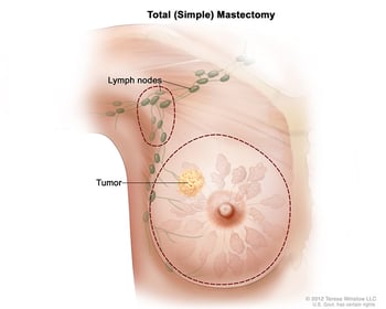mastectomy-wvci-breast-cancer-surgery-type