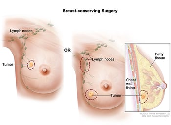 wvci-breast-conserving-surgery-breast-cancer-surgeon